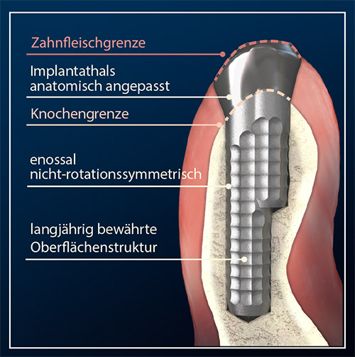 INDI Implantat, schematische Darstellung