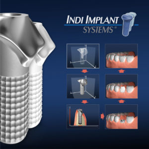 INDI Implantat Produkt-Workflow